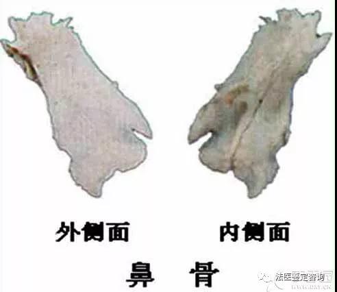 鼻骨骨折的法医临床鉴定