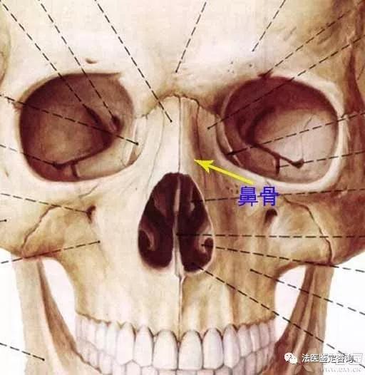 鼻骨骨折的法医临床鉴定