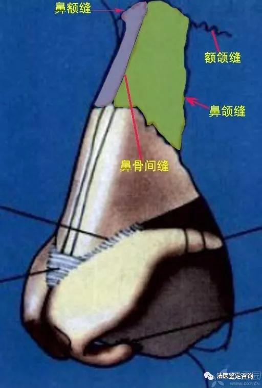 鼻骨骨折的法医临床鉴定