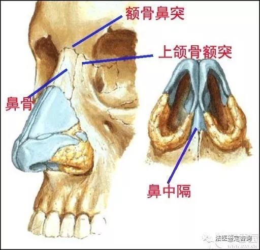 鼻骨骨折的法医临床鉴定