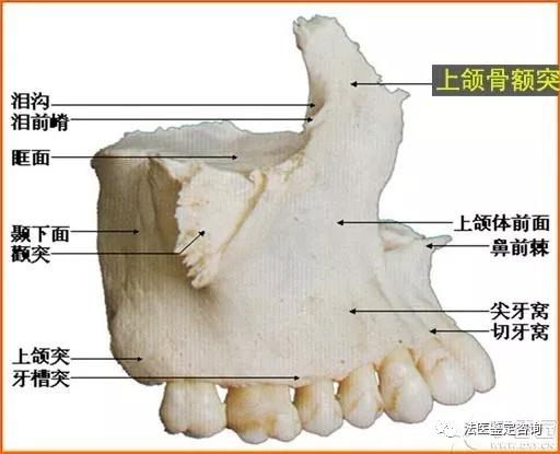 鼻骨骨折的法医临床鉴定