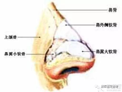 鼻骨骨折的法医临床鉴定