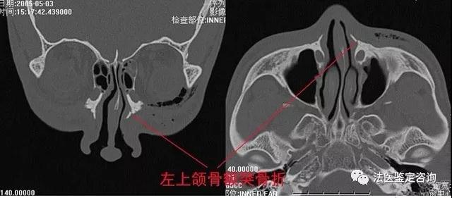 鼻骨骨折的法医临床鉴定