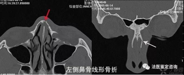 鼻骨骨折的法医临床鉴定