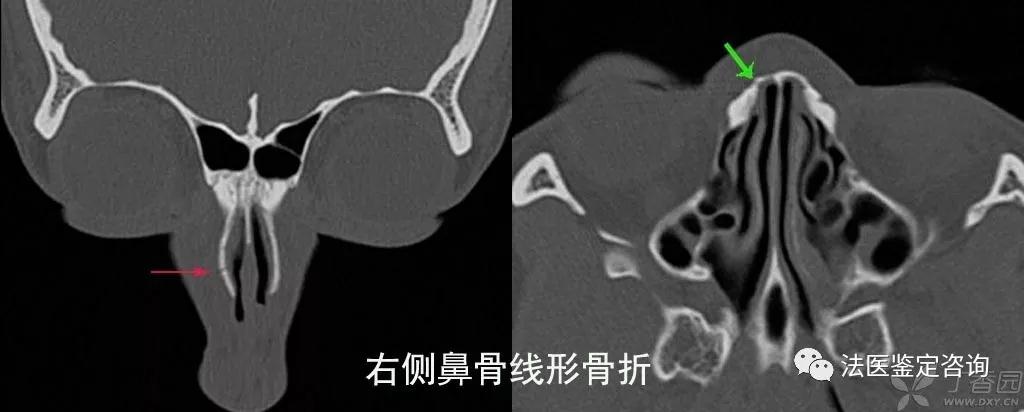 鼻骨骨折的法医临床鉴定