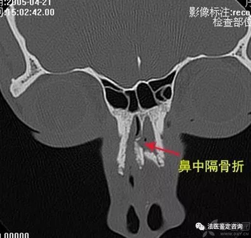 鼻骨骨折的法医临床鉴定