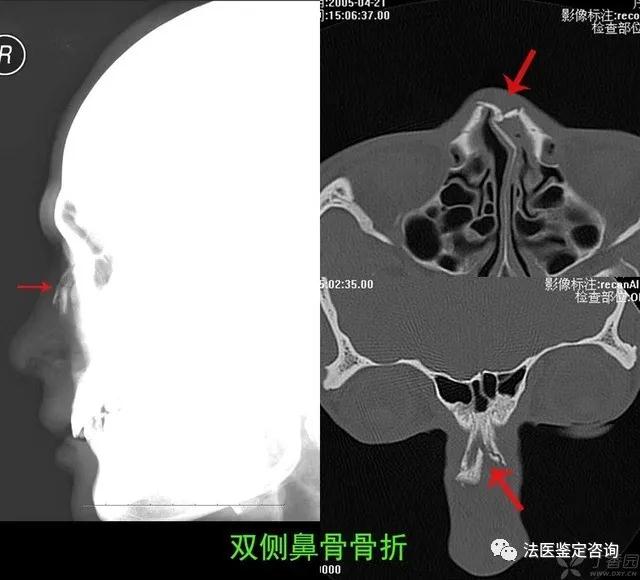 鼻骨骨折的法医临床鉴定