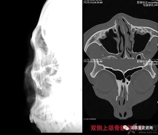 鼻骨骨折的法医临床鉴定