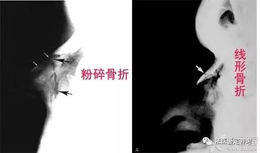 鼻骨骨折的法医临床鉴定
