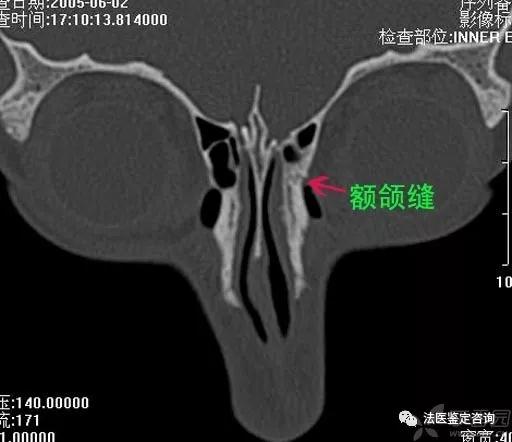 鼻骨骨折的法医临床鉴定