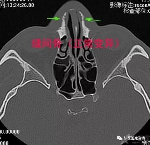 鼻骨骨折的法医临床鉴定