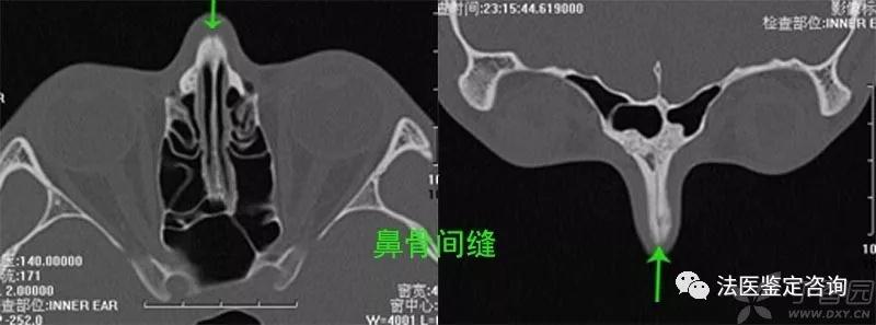 鼻骨骨折的法医临床鉴定