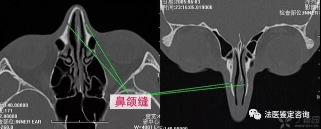 鼻骨骨折的法医临床鉴定