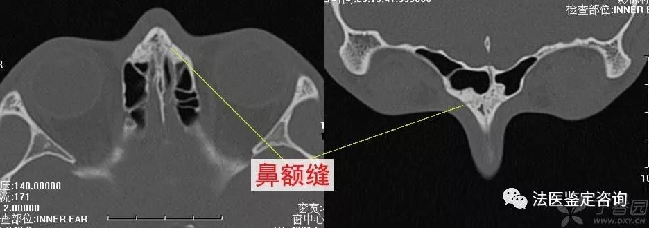 鼻骨骨折的法医临床鉴定