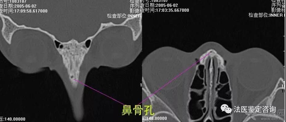 鼻骨骨折的法医临床鉴定